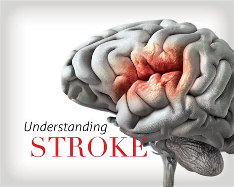 Understanding Stroke HealthScope