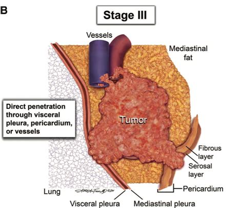 Staging Foundation For Thymic Cancer Research