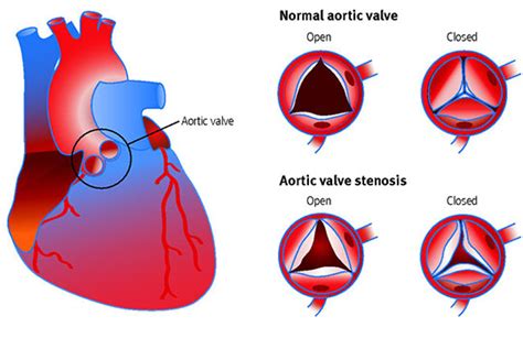 Aortic Stenosis Diagnosis And Management The Bmj