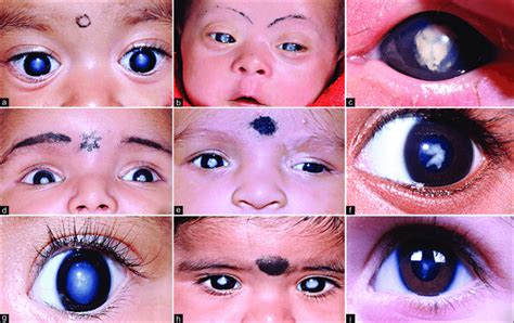 Congenital Cataracts In Adults
