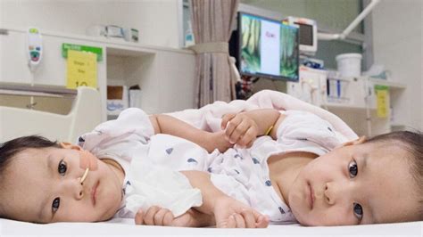 Conjoined Bhutanese Twins Undergo Separation Surgery In Melbourne