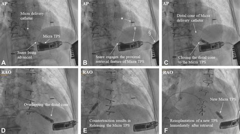 Fluoroscopic Views Of Leadless Pacemaker Retrieval Download