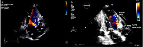 Cureus Worsening Mitral Stenosis Due To Post Transcatheter Aortic