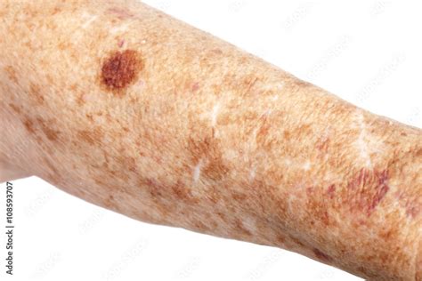 Female Senior Citizen Arm With Age Spots Also Known As Liver Spots