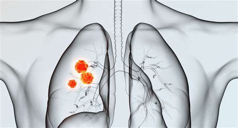Lungenkrebs Bronchialkarzinom Symptome Diagnose Therapie Krebs Tumor My Xxx Hot Girl