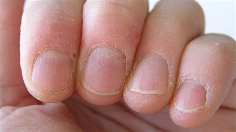 Why Are My Fingernails Peeling And Splitting Design Talk