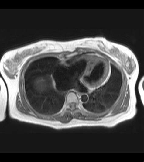 Infundibular Pulmonary Stenosis Image