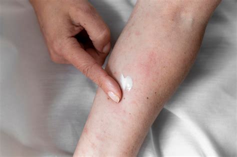 Understanding The Difference Rash Vs Hives A Comprehensive Guide