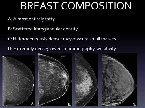 Pin On Breast Ultrasound