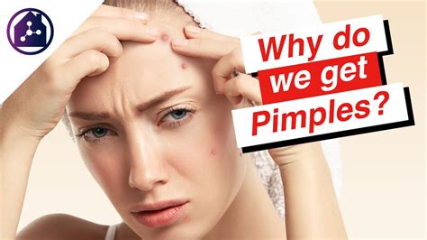 Why Do We Get Pimples Health Daily Advice