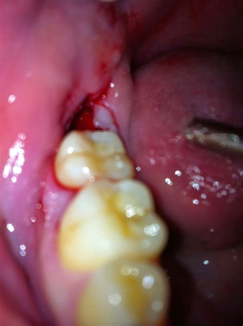Gum Infection Drbeckmann
