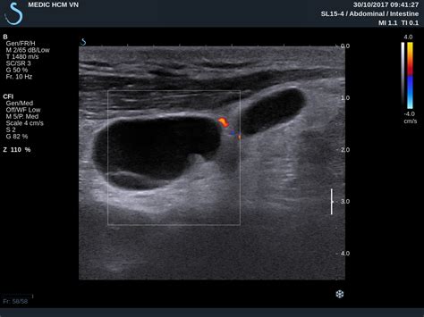 Swollen Lymph Nodes In Neck Ultrasound