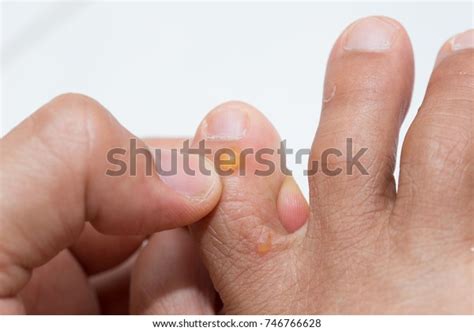 Closeup Foot Dyshidrotic Eczema Isolated White Stock Photo Edit Now