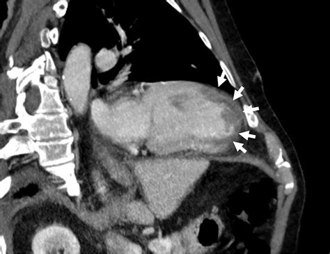 E Ct Scan Of The Heart Following Iodine Contrast Injection 2 Chamber