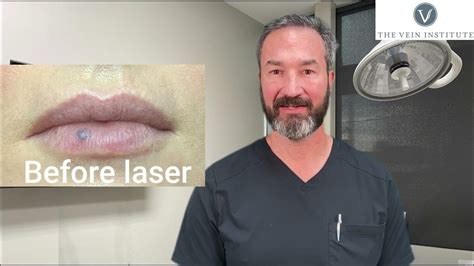 Venous Lake Of The Liplip Blister Treatment And Removal Youtube