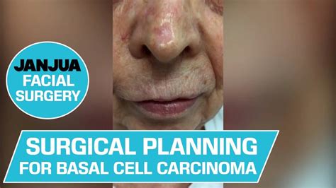 Surgical Planning For Basal Cell Carcinoma Of The Nose Dr Tanveer