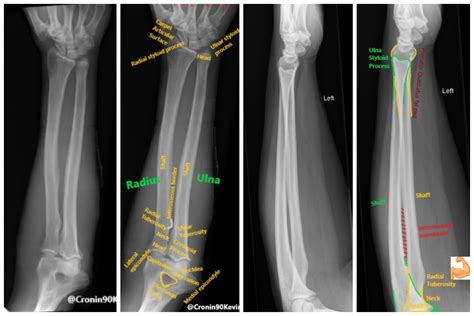 Radiographic Anatomy Of The Forearm Radiologypics Com My Xxx Hot Girl