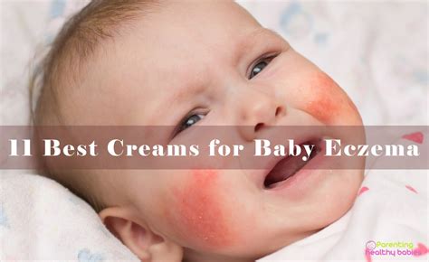 11 Best Creams Oils And Lotions To Treat Eczema In Babies