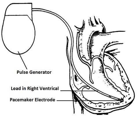 Artificial Pacemaker With Pulse Generator Lead And Electrode