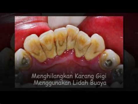 Cara menghilangkan karang gigi selanjutnya juga dapat dilakukan dengan berkumur menggunakan mouthwash. cara menghilangkan karang gigi dengan soda kue - YouTube