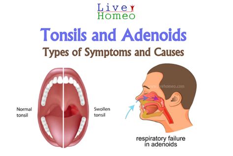 Symptoms Of Tonsils And Adenoids Homeopathy Treatment Live Homeo