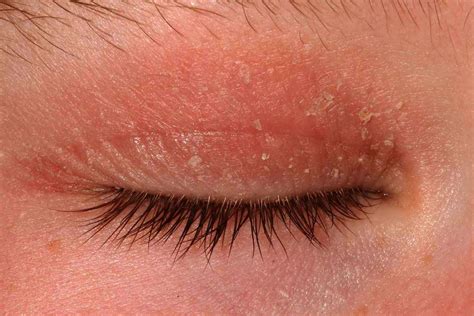 Eyelid Dermatitis Symptoms Causes And Treatments