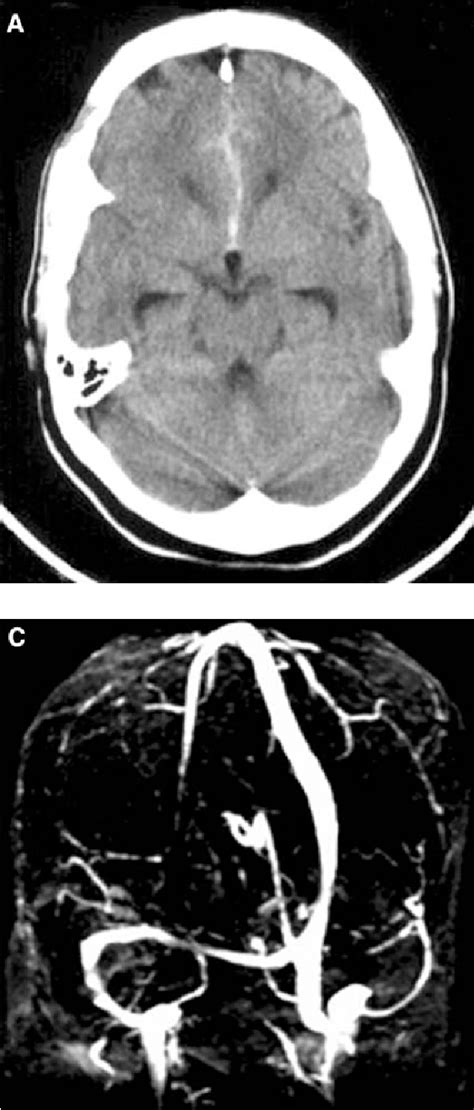 Figure 1 From Subarachnoid Hemorrhage Following Chronic Dural Venous