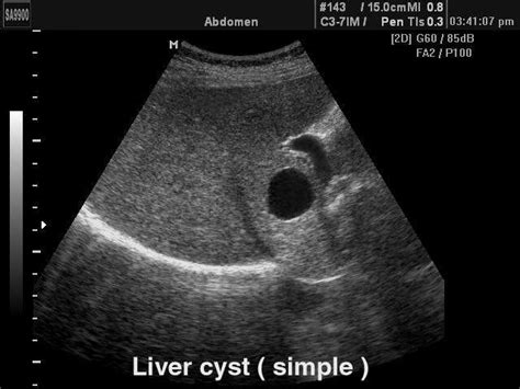 Ultrasound Images Liver Simple Cyst B Mode Echogramm №156