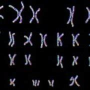 Down S Syndrome Karyotype Photograph By Kateryna Kon Science Photo