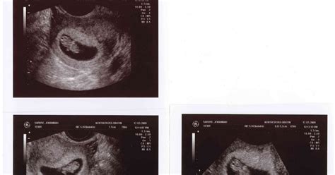 My Baby Blog Ultrasound At 8 Weeks