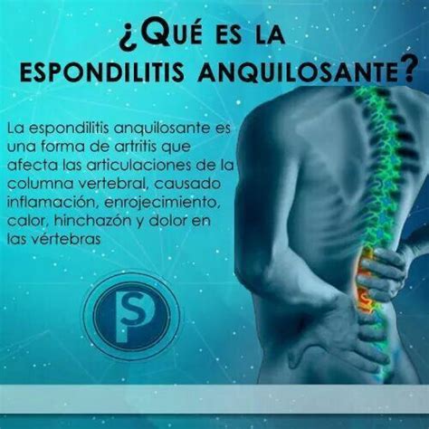 Qué es la EA Espondilitis anquilosante Espondilitis Anatomia y