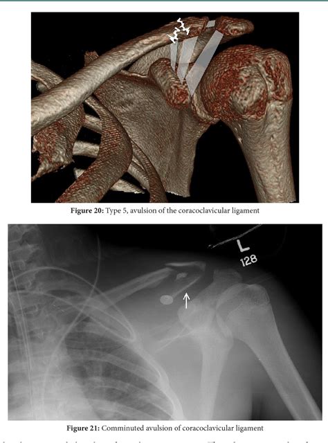 Pdf Clavicle Fractures Allman And Neer Classification Semantic Scholar