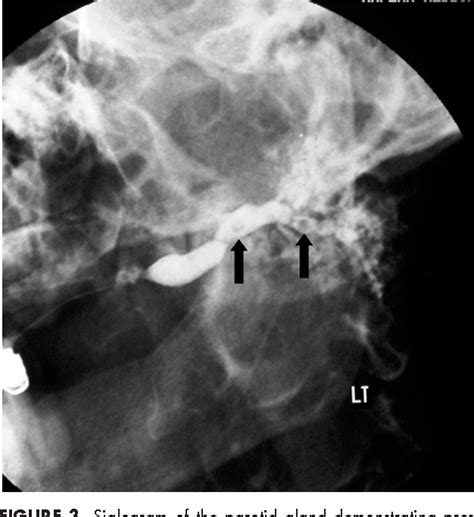 Figure 9 From Modern Sialography For Screening Of Salivary Gland
