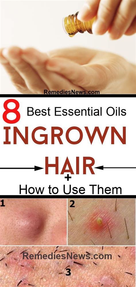 How To Use Essential Oils For Ingrown Hair 8 Best Home Remedies Ingrown Hair Ingrown Hair