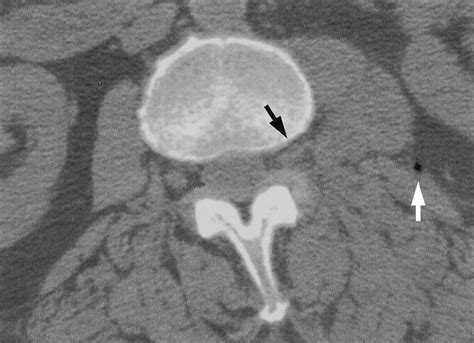 Lumbar Spine Axial Computed Tomography Scans At L2l3 Foramen Level At