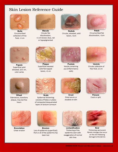 Image Result For Skin Lesion Guide Dermatology Nurse Wound Care
