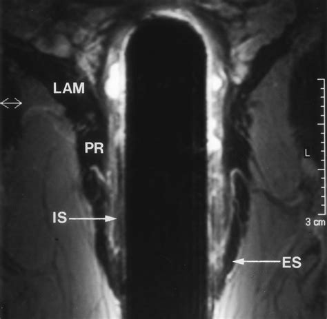 Endoanal Mr Imaging Of The Anal Sphincter In Fecal Incontinence Radiographics