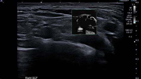 Efsumb Case Of The Month May Supraclavicular Node Msmi Youtube