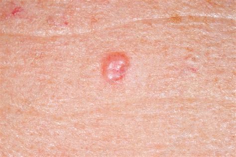 Signs Of Skin Cancer On Leg