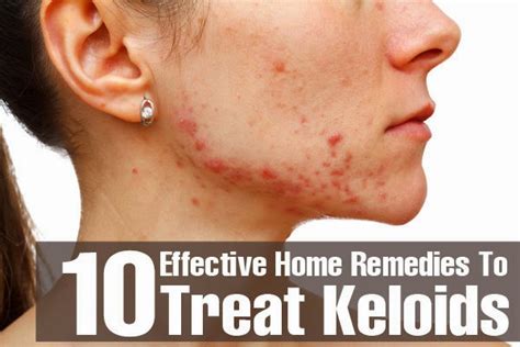 Top 10 Effective Home Remedies To Treat Keloids Mzizi Mkavu