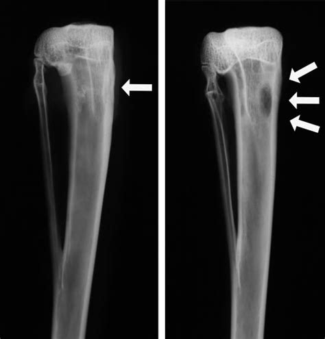 Plain Radiographs Demonstrating A Healing Defect Arrow Of The