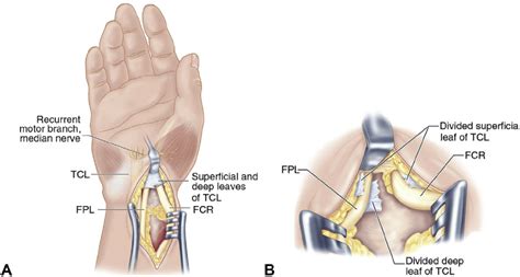 Single Incision Extensile Volar Approach To The Distal Radius And