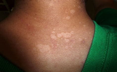 Splotchy Skin Backbodyneck Acne By Ance101 Community