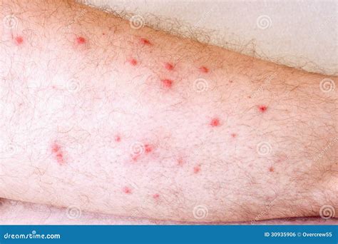 Allergy Royalty Free Stock Image Image 30935906