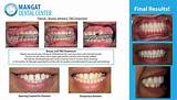 Pictures of Invisalign Tmj Treatment
