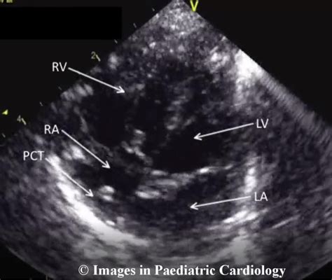Transthoracic Echocardiogram Of Infant Subcostal Apical View Showing
