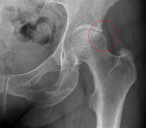 Things You Should Know About Hip Pain Due To Hip Impingement And Your X