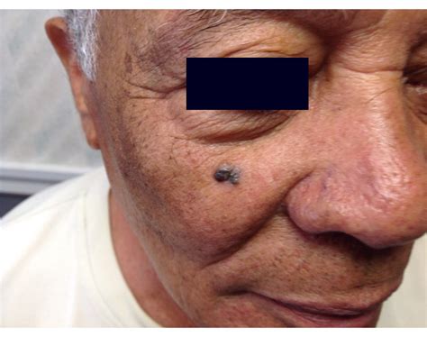 Dermdx Hispanic Man With Facial Lesion Of Increasing Size