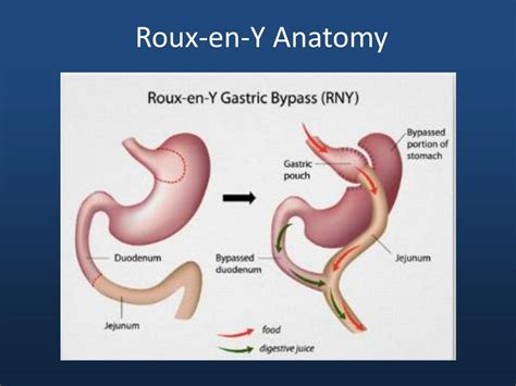 Ppt Gi Complications Of Gastric Bypass Powerpoint Presentation Free Download Id 2244887