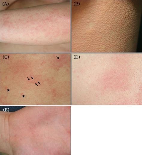 Urticaria Chronic Hives Causes Types Diagnosis And Treatment